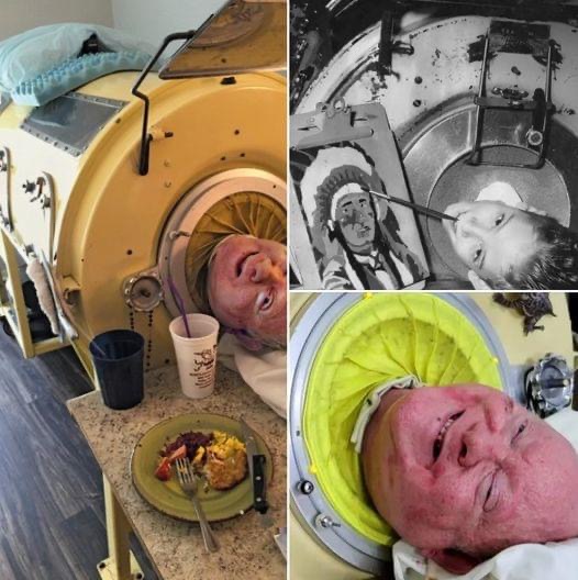 76-year-old man, paralyzed from polio at 6, is one of the last people with an iron lung: ‘My life is incredible’